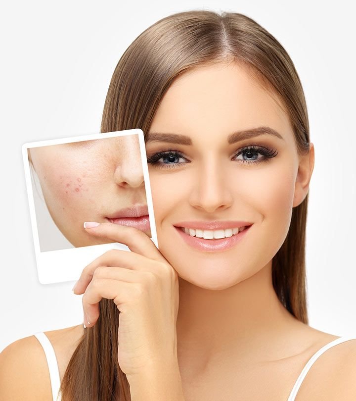 Effective acne solutions for clear skin for a glowing complexion