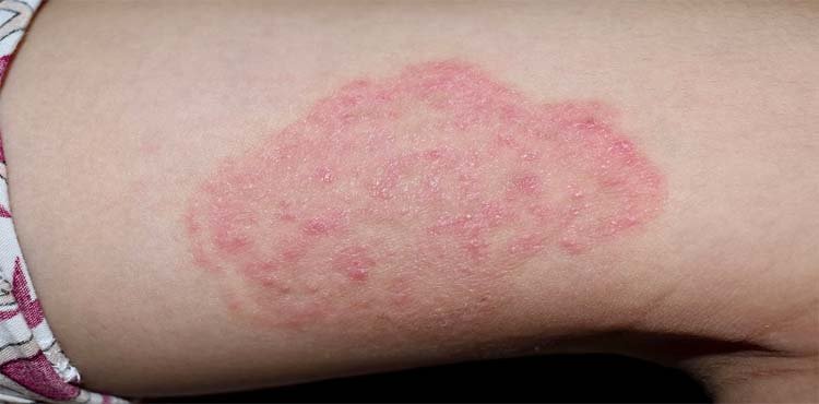 Fungal skin infections: Types, symptoms and treatment