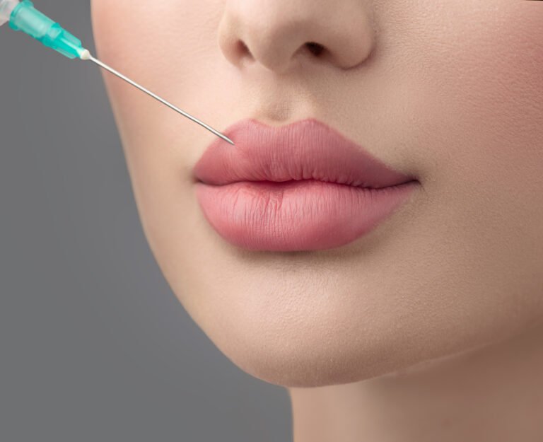 Russian Lip Fillers in Dubai