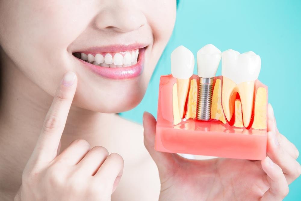 Why Busy Professionals Are Choosing Affordable Dental Implants