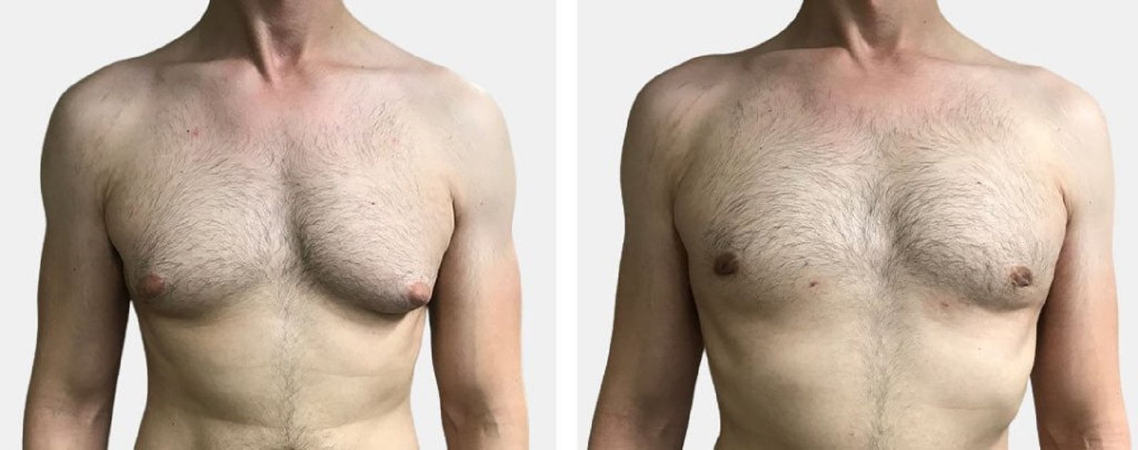 gynecomastia surgery in dubai abu dhabi sharjah