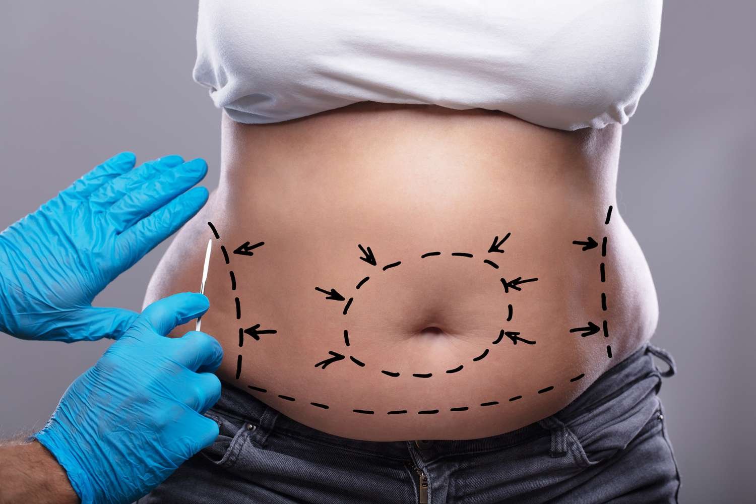 Tummy Tuck In Dubai