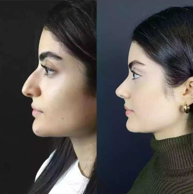 Rhinoplasty in Dubai: Procedure, Cost, and What to Expect